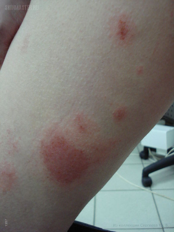 Экзема микробная (монетовидная) и гепатит В. Случай №459. Клинические ...